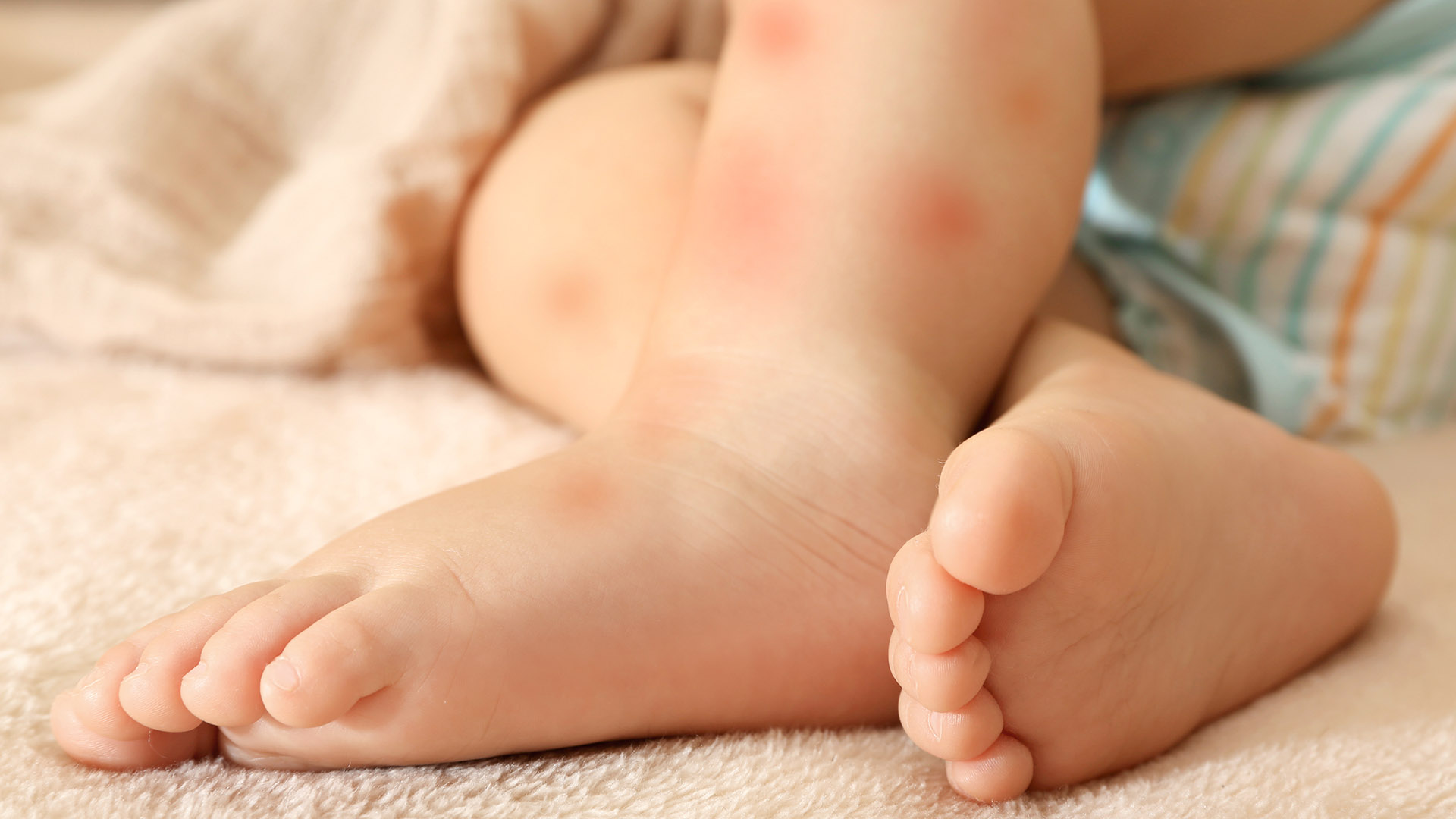 Аллергические пятна на ногах у ребенка