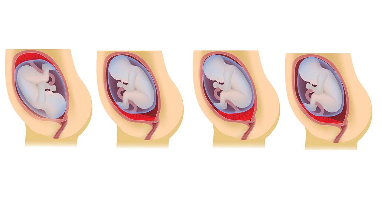 Краевое предлежание плаценты по передней стенке: 📌 вопросы гинекологии и советы по лечению